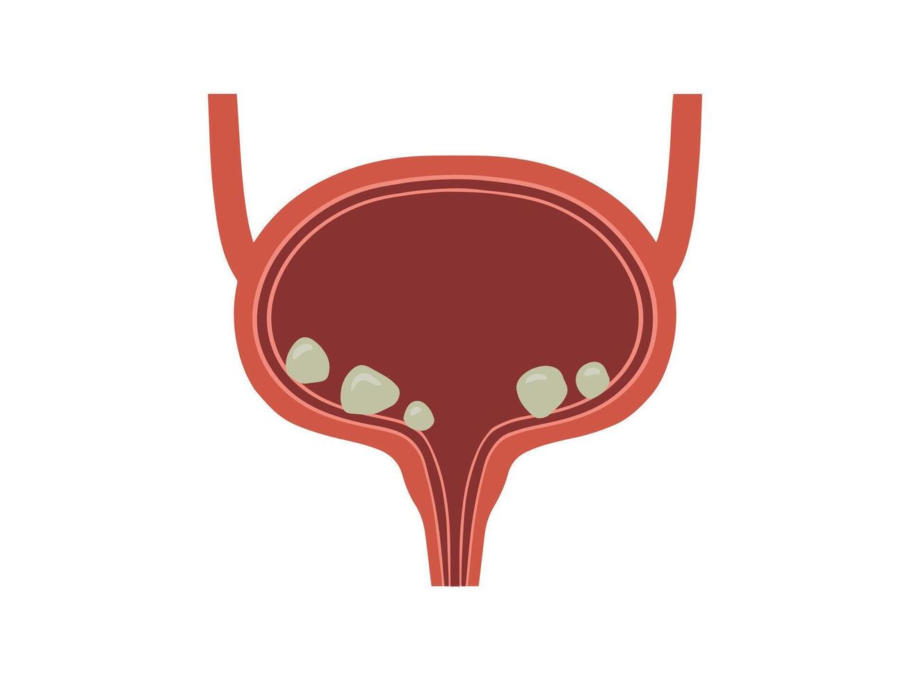 3mm kidney stone
