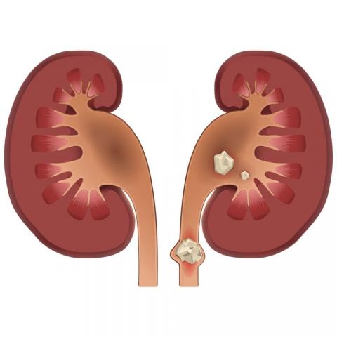 Kidney Stone Doctor