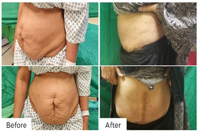 ABDOMINOPLASTY