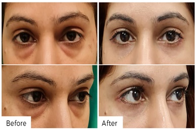 EYELID SURGERY