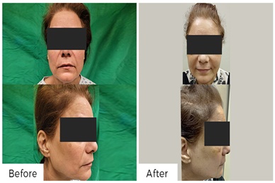 FACIAL REJUVINATION