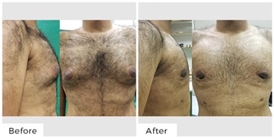 GYNAECOMASTIA GYNAECOMASTIA