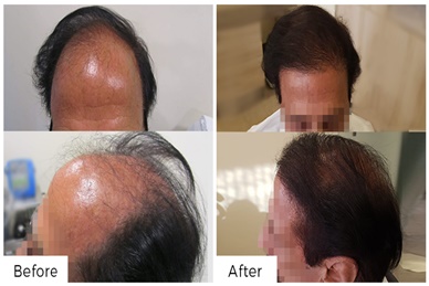 HAIR TRANSPLANTATION