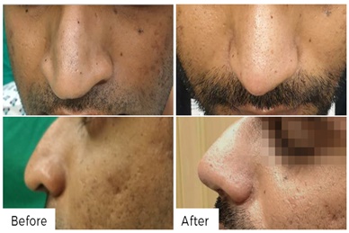 RHINOPLASTY