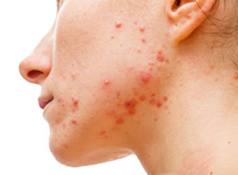 pcos acne treatment in karachi